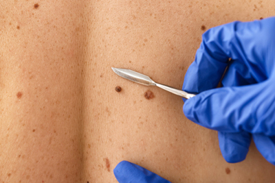 Mole-ready-to-remove Small-knife-ready-to-remove-the-mole-in-back-of-patient.
