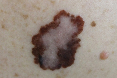 Skin-Cancer-Treatment-in-Jackson-and-Humboldt-TN